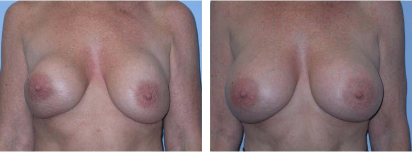 Breast Revision Before & After Gallery - Patient 74827526 - Image 1