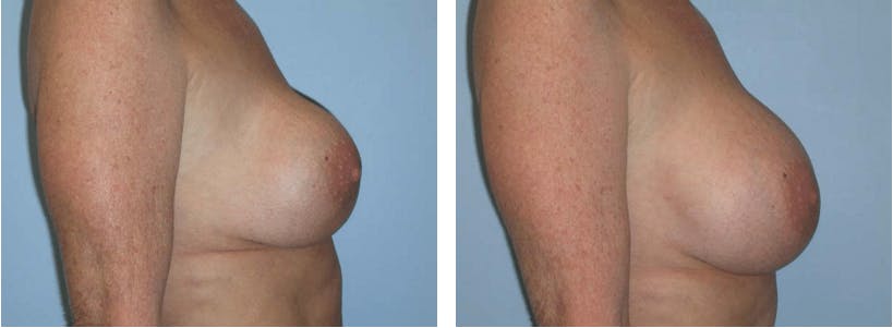 Breast Revision Before & After Gallery - Patient 74827526 - Image 2