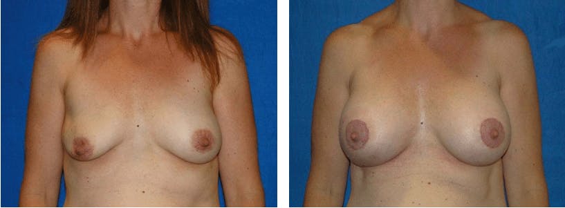 Breast Revision Before & After Gallery - Patient 74827527 - Image 1