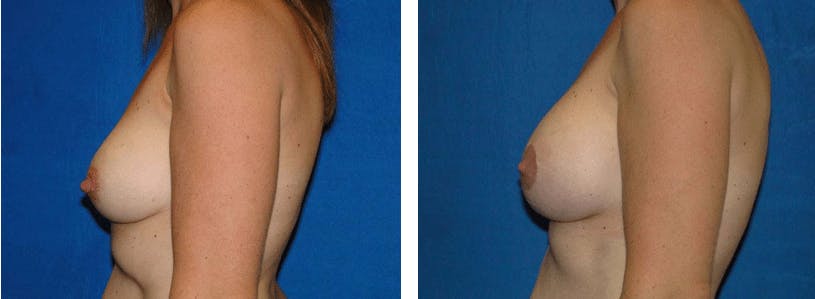 Breast Revision Before & After Gallery - Patient 74827527 - Image 2