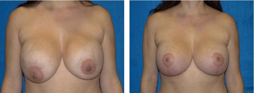 Breast Revision Before & After Gallery - Patient 74827528 - Image 1