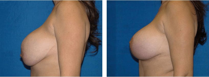 Breast Revision Before & After Gallery - Patient 74827528 - Image 2