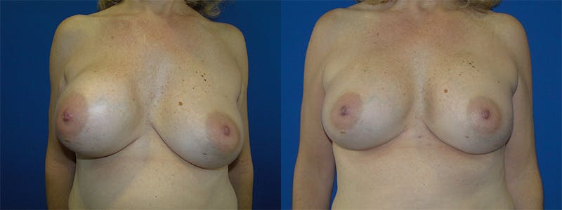 Breast Revision Before & After Gallery - Patient 74827529 - Image 1