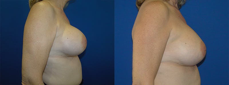 Breast Revision Before & After Gallery - Patient 74827529 - Image 2