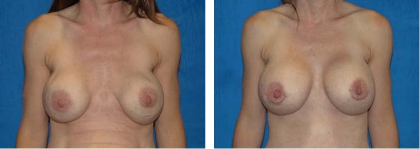 Breast Revision Before & After Gallery - Patient 74827530 - Image 1