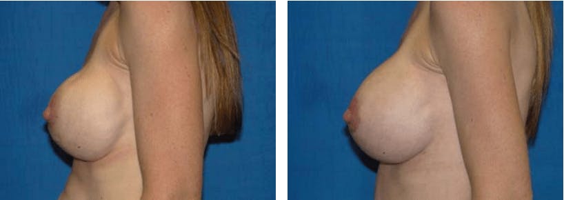 Breast Revision Before & After Gallery - Patient 74827530 - Image 2