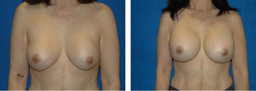 Breast Revision Before & After Gallery - Patient 74827531 - Image 1