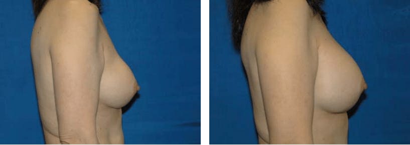 Breast Revision Before & After Gallery - Patient 74827531 - Image 2