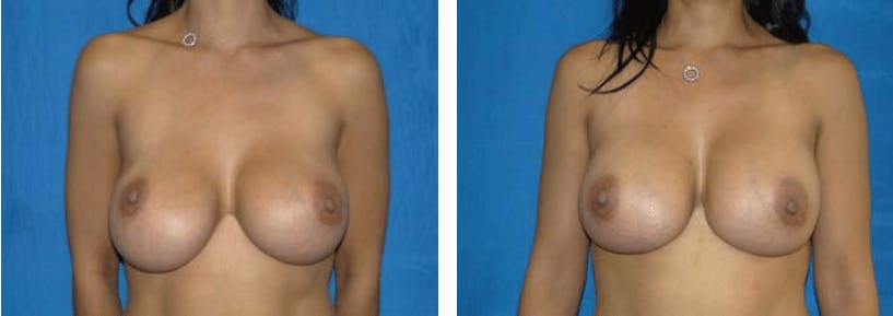Breast Revision Before & After Gallery - Patient 74827532 - Image 1