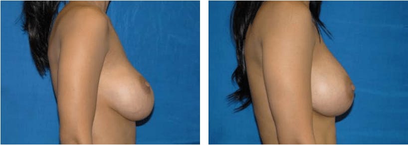 Breast Revision Before & After Gallery - Patient 74827532 - Image 2