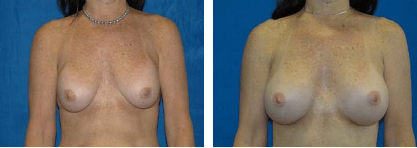 Breast Revision Before & After Gallery - Patient 74827534 - Image 1