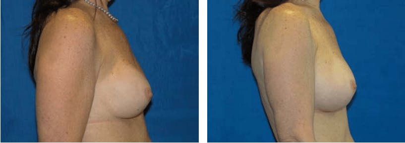 Breast Revision Before & After Gallery - Patient 74827534 - Image 2