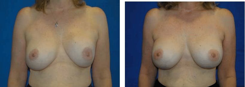 Breast Revision Before & After Gallery - Patient 74827535 - Image 1