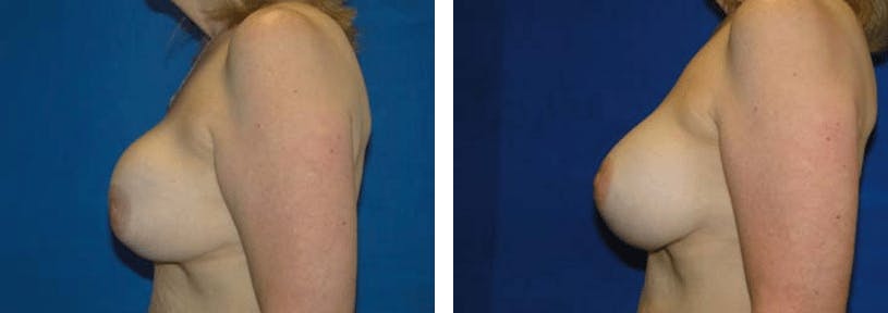Breast Revision Before & After Gallery - Patient 74827535 - Image 2