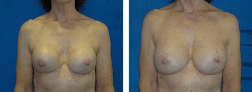 Breast Revision Before & After Gallery - Patient 74827545 - Image 1