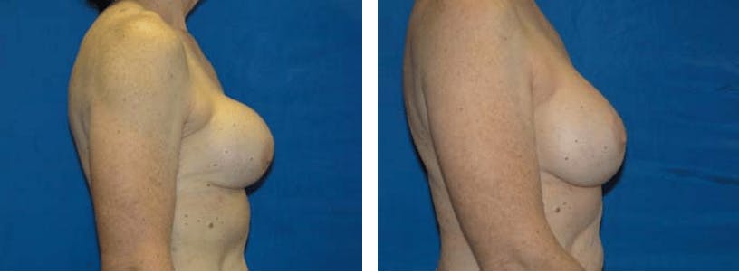 Breast Revision Before & After Gallery - Patient 74827545 - Image 2