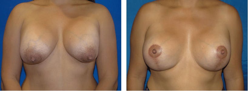 Breast Revision Before & After Gallery - Patient 74827565 - Image 1