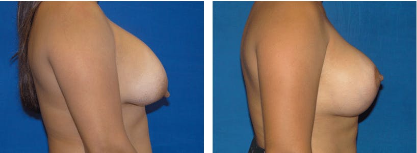 Breast Revision Before & After Gallery - Patient 74827565 - Image 2