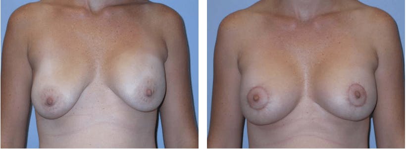 Breast Revision Before & After Gallery - Patient 74827580 - Image 1