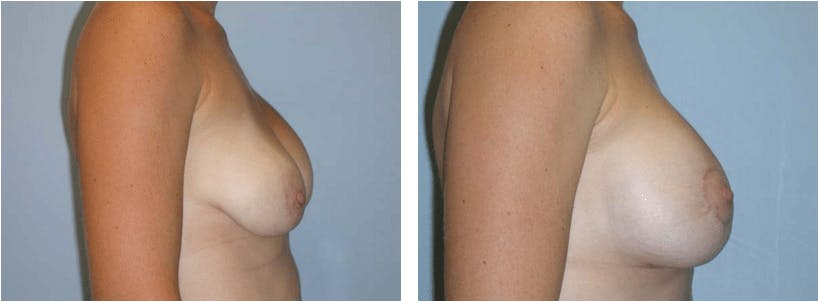 Breast Revision Before & After Gallery - Patient 74827580 - Image 2