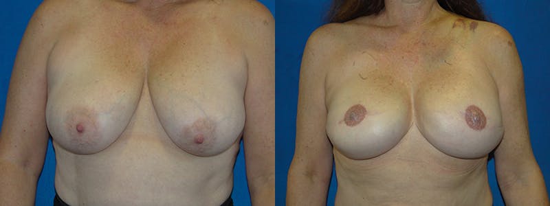 Breast Reconstruction Before & After Gallery - Patient 74827660 - Image 1