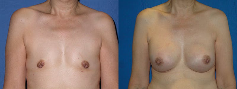 Breast Reconstruction Before & After Gallery - Patient 74827663 - Image 1