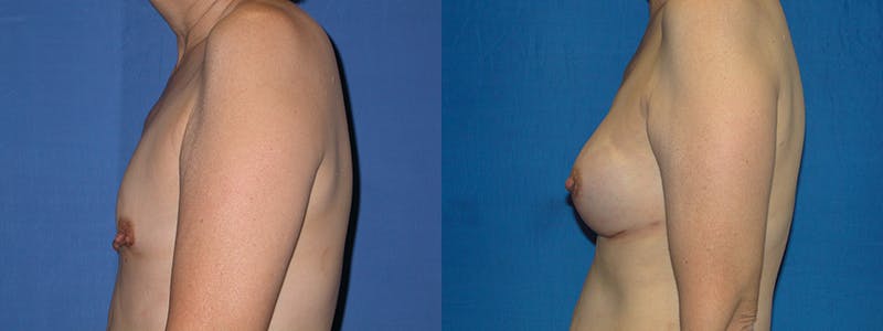 Breast Reconstruction Before & After Gallery - Patient 74827663 - Image 2