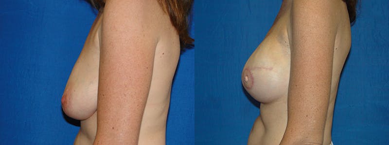 Breast Reconstruction Before & After Gallery - Patient 74827673 - Image 2