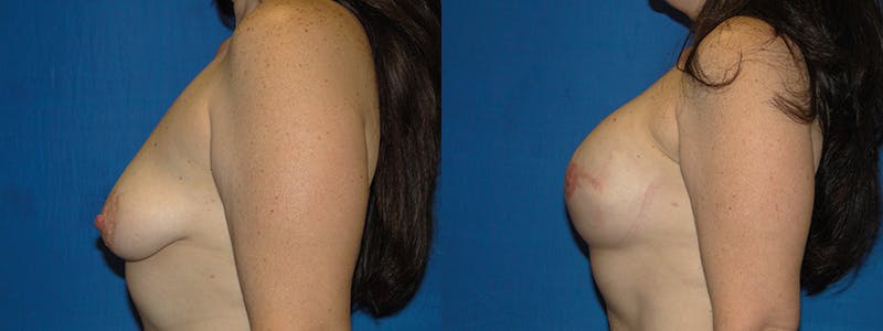 Breast Reconstruction Before & After Gallery - Patient 74827679 - Image 2
