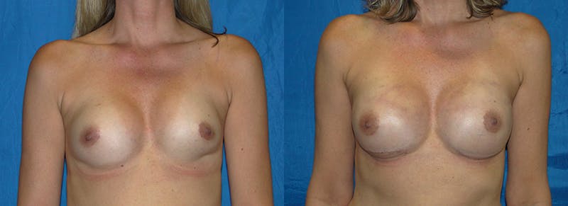Breast Reconstruction Before & After Gallery - Patient 74827688 - Image 1