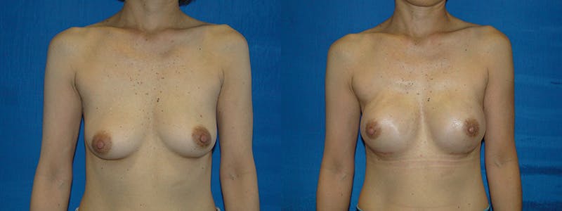 Breast Reconstruction Before & After Gallery - Patient 74827694 - Image 1