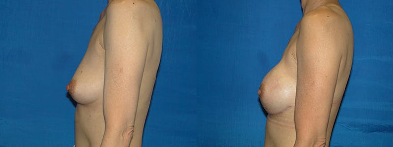 Breast Reconstruction Before & After Gallery - Patient 74827694 - Image 2
