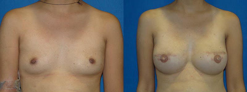 Breast Reconstruction Before & After Gallery - Patient 74827703 - Image 1