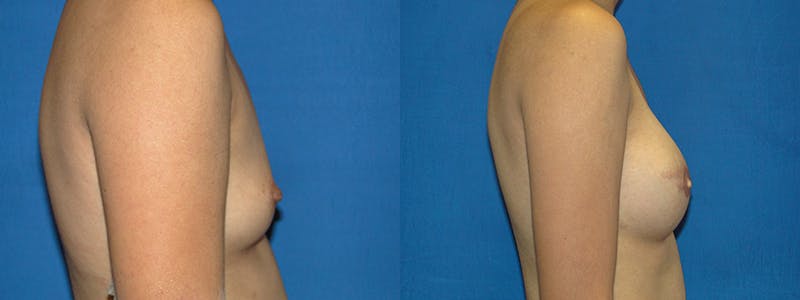 Breast Reconstruction Before & After Gallery - Patient 74827703 - Image 2