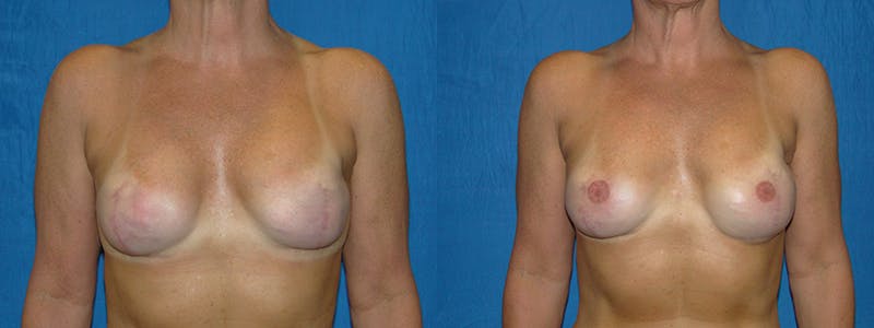 Breast Reconstruction Before & After Gallery - Patient 74827709 - Image 1
