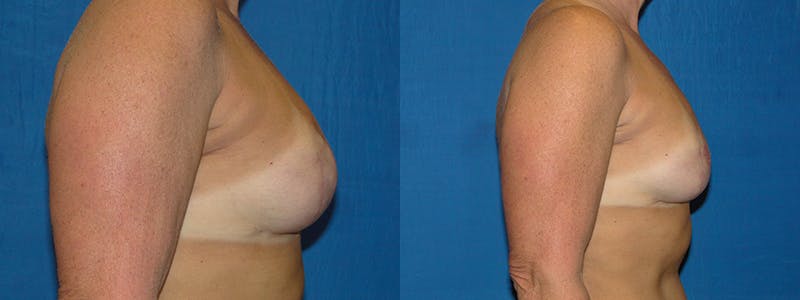 Breast Reconstruction Before & After Gallery - Patient 74827709 - Image 2