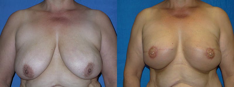 Breast Reconstruction Before & After Gallery - Patient 74827714 - Image 1