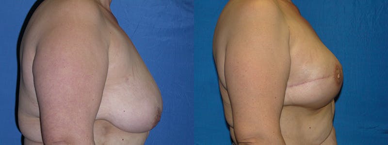 Breast Reconstruction Before & After Gallery - Patient 74827714 - Image 2
