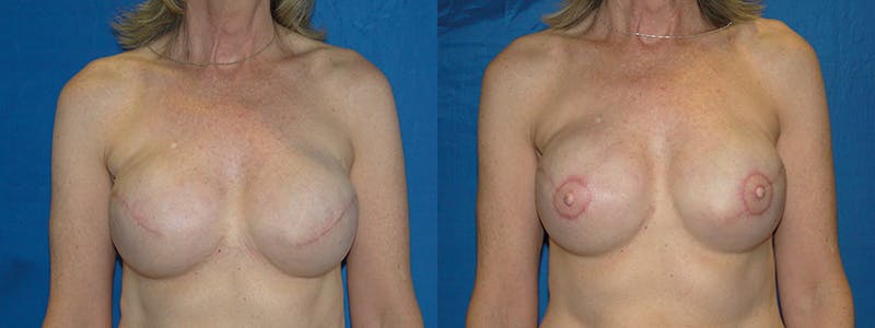 Breast Reconstruction Before & After Gallery - Patient 74827719 - Image 1