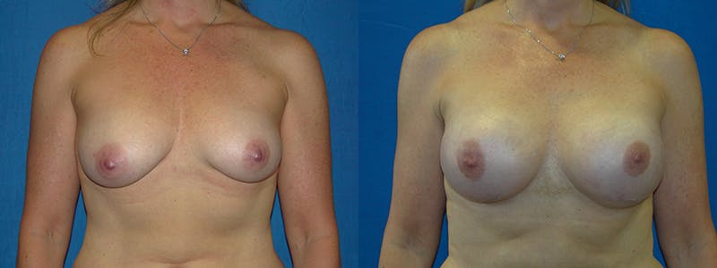 Breast Reconstruction Before & After Gallery - Patient 74827727 - Image 1