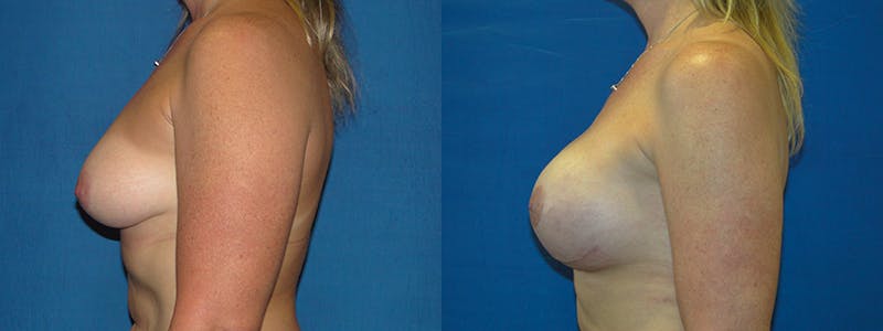 Breast Reconstruction Before & After Gallery - Patient 74827727 - Image 2
