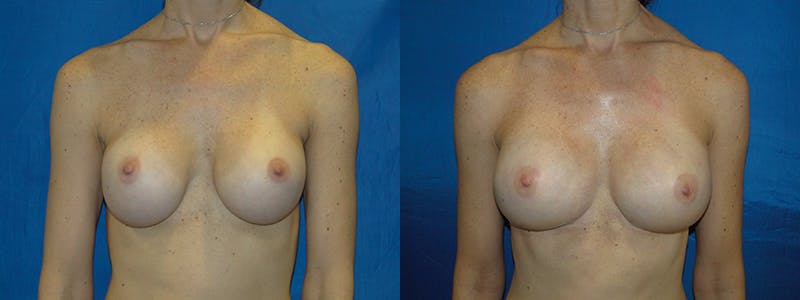 Breast Reconstruction Before & After Gallery - Patient 74827732 - Image 1