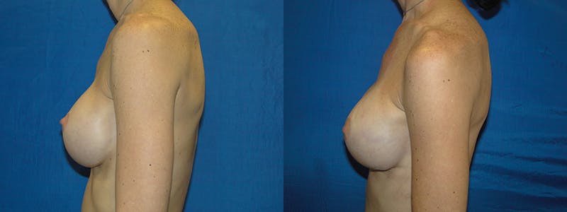 Breast Reconstruction Before & After Gallery - Patient 74827732 - Image 2
