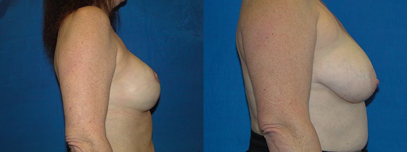Breast Reconstruction Before & After Gallery - Patient 74827734 - Image 2