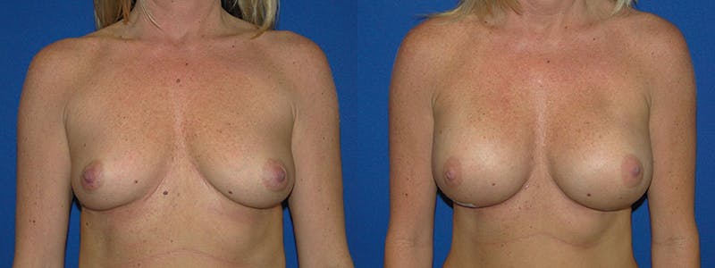 Breast Reconstruction Before & After Gallery - Patient 74827737 - Image 1