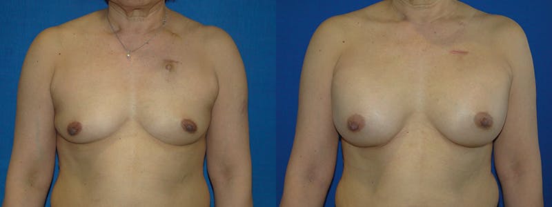 Breast Reconstruction Before & After Gallery - Patient 74827740 - Image 1