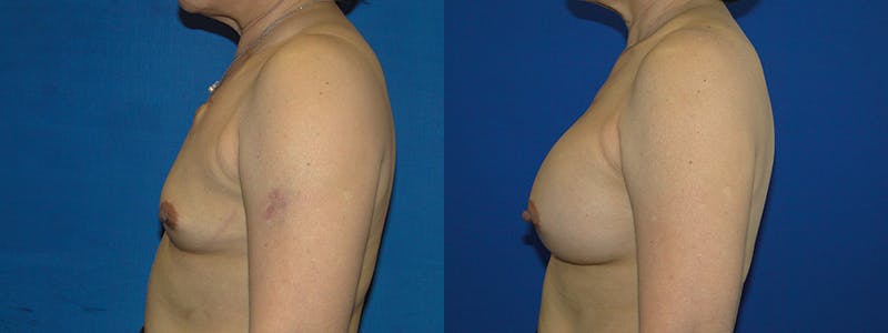 Breast Reconstruction Before & After Gallery - Patient 74827740 - Image 2