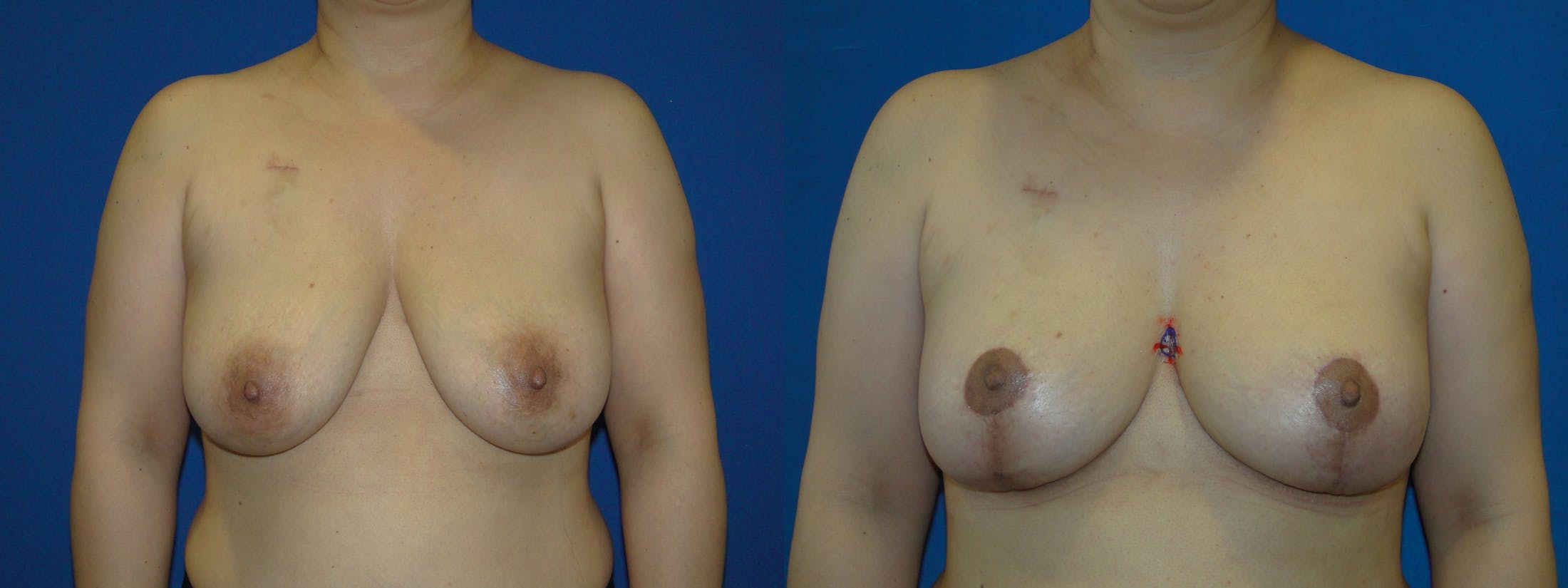 Breast Reconstruction Before & After Gallery - Patient 74827792 - Image 1
