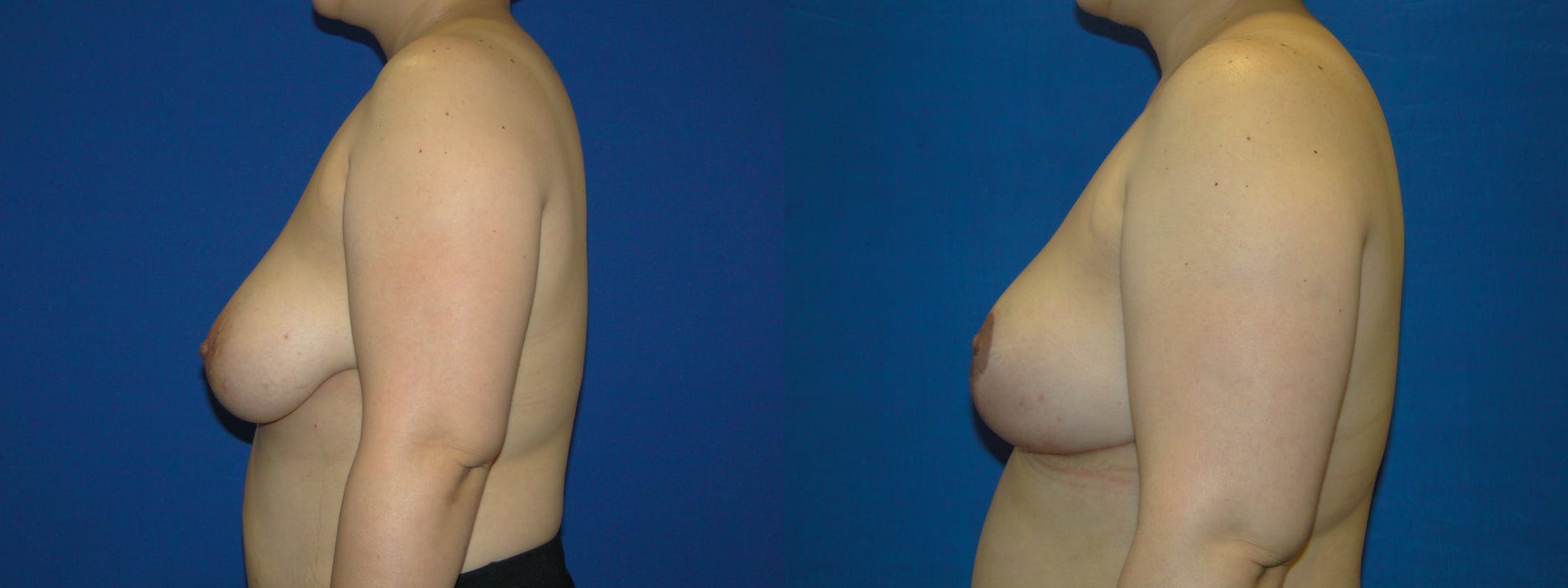 Breast Reconstruction Before & After Gallery - Patient 74827792 - Image 2