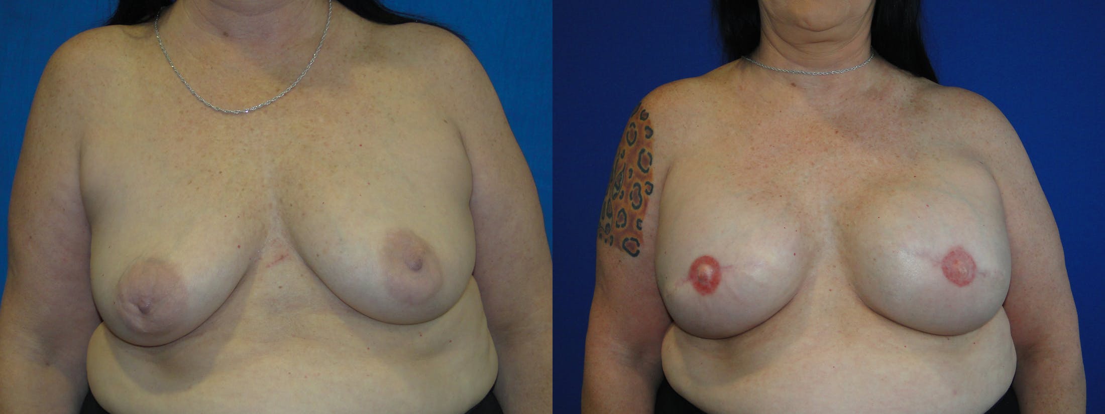 Breast Reconstruction Before & After Gallery - Patient 74827855 - Image 1